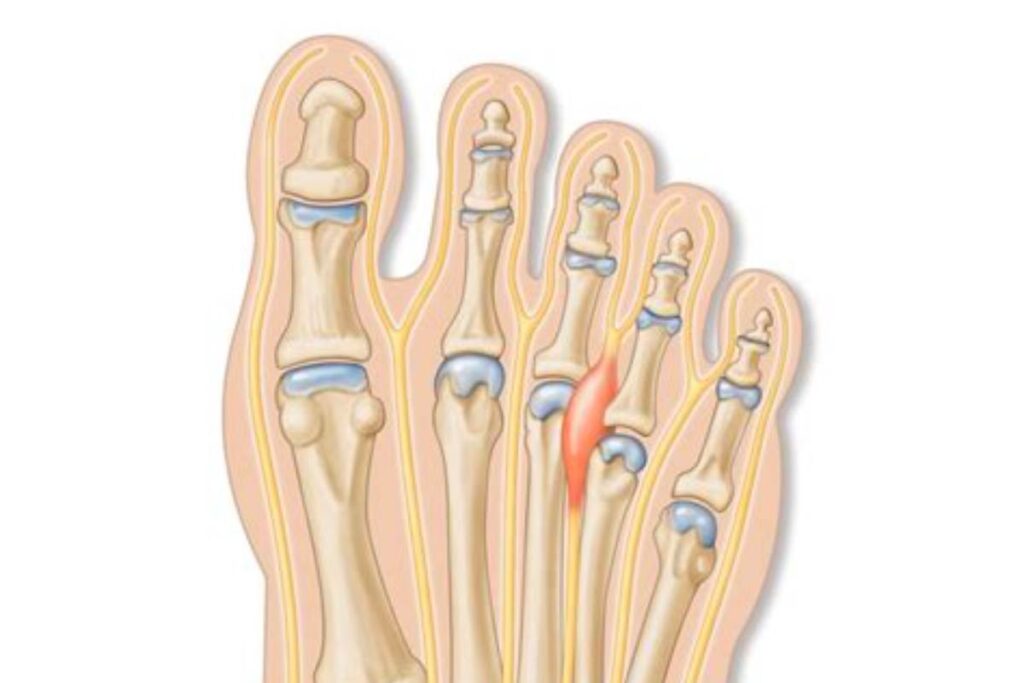 DL Walker Consultant Neuromas