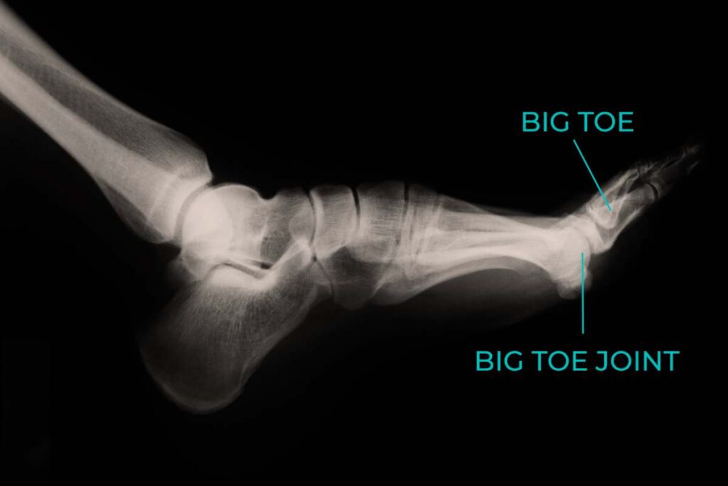 DL Walker Consultant Turf Toe Injury